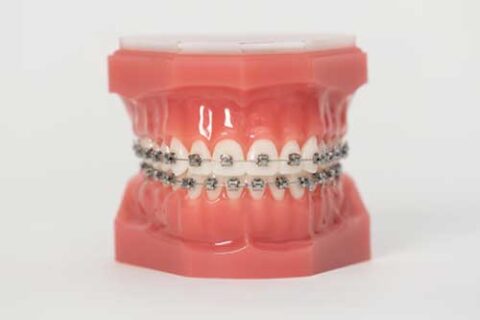 Damon Metal Braces for Teen in McHenry | Conlon Thompson Orthodontics