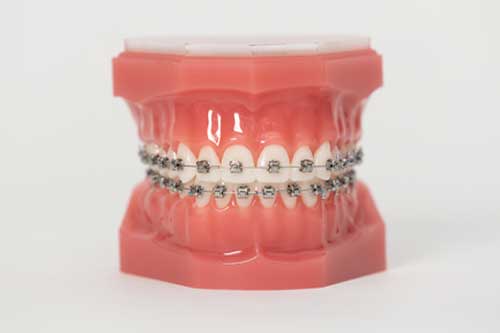 What to do in Case of an Orthodontic Emergency?